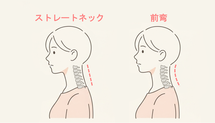 ストレートネックと正常な頚椎前弯の図