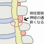 脊柱菅狭窄症とは