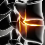 椎間板ヘルニア